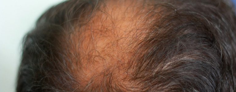Header image for article about natural treatments for hair loss in men and women